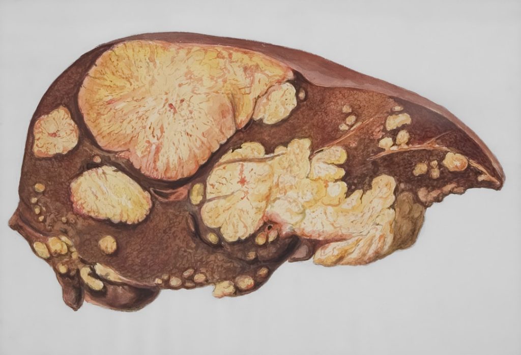 Pancreas Problems: Symptoms, Causes, Diagnosis & Best Treatment Options in Bangladesh