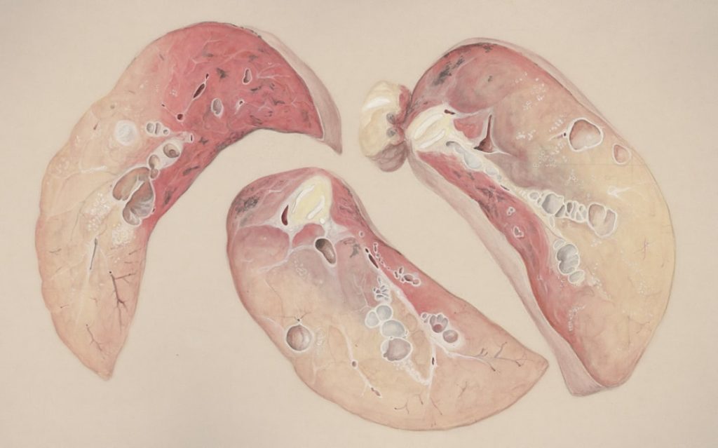 Liver Cyst: Classification, Imaging-Based Diagnosis, and Management Options from Surveillance to Intervention