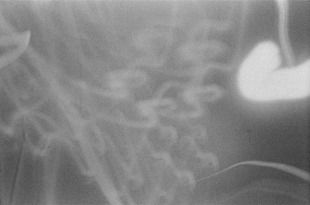 Spleen Rupture Emergency Guide With Symptoms, Immediate Tests, and Life Saving Treatment